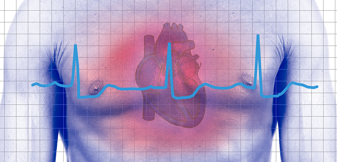 Silent Heart Attacks - Cleveland HeartLab, Inc.