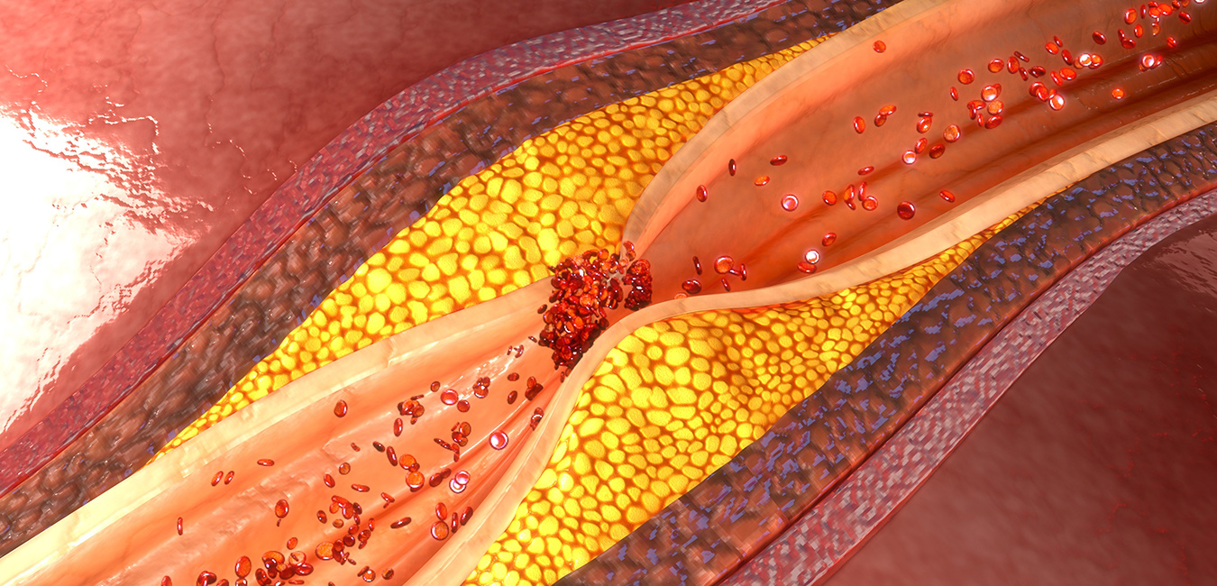 Detecting Hidden Heart Disease Before it Harms Cleveland HeartLab, Inc.